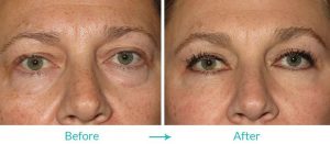 lower eyebags treatment eyesthetica