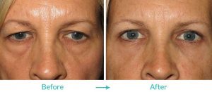eyesthetica upper and lower blepharoplasty surgery