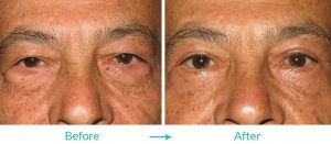 saggy eyelid treatment in california