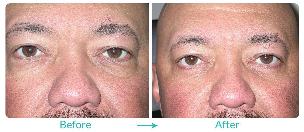 under eye skin aging treatment