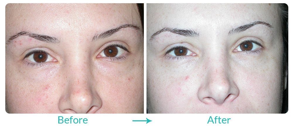 Case 217 lower blepharoplasty surgery for a younger looking you