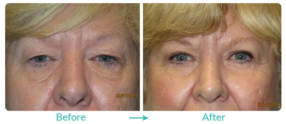 under eye bags and wrinkles surgery