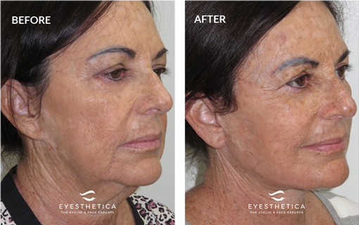 Middle-aged woman before and after facelift