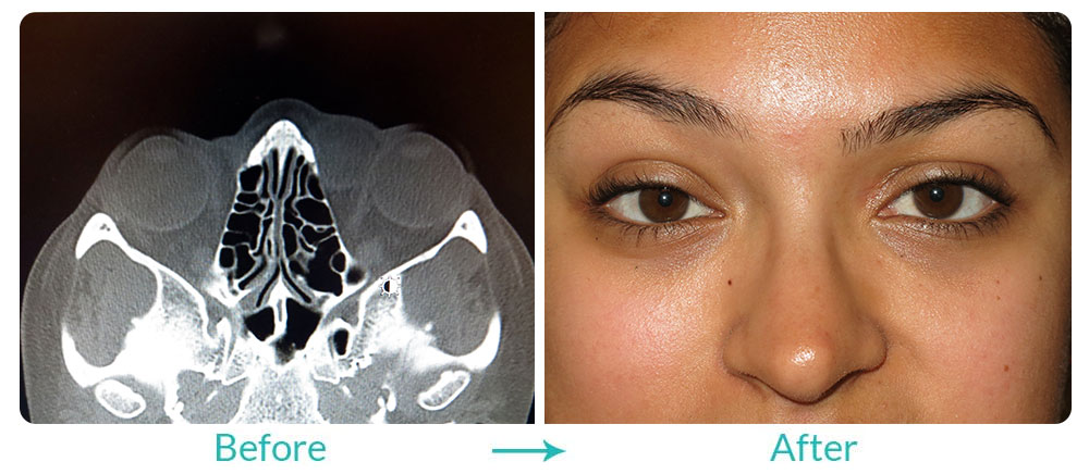 orbital tumors and disorders