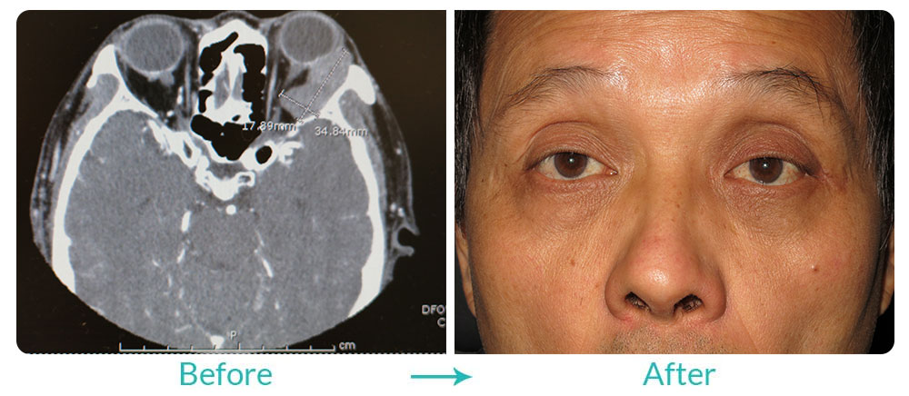 Orbital Tumor Treatment Case-144