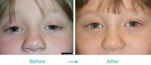 eyelid surgery for children