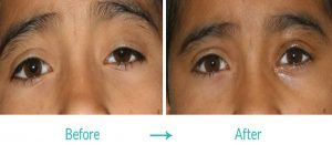bilateral upper eyelid ptosis repair