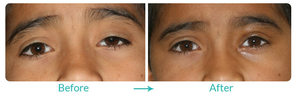 bilateral upper eyelid ptosis repair