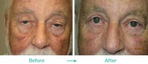 eyelid lift and eyelid turning out treatment