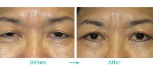 Before and After Ptosis surgery