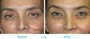 fillers and droopy eyelids surgery