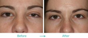 Ptosis or Blepharoptosis