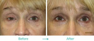 best Ptosis repair treatment in california