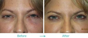 professional ptosis repair