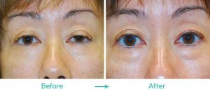 eyesthetica ptosis case 193