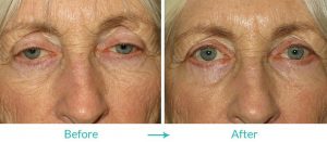 Ptosis and lower eyelid surgery