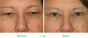 droopy eyelids procedure