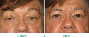 eyesthetica ptosis surgery in Los Angeles