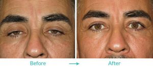 Ptosis repair for men