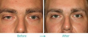 eyesthetica droopy eyelid procedure