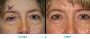 ptosis treatment for droopy eyelids
