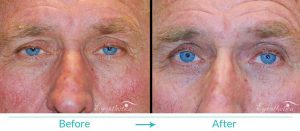 droopy eyelid surgery