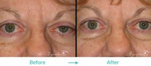 right eyelid ptosis procedure
