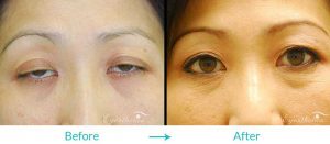 Ptosis treatment for asians