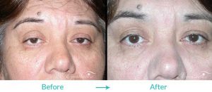 droopy eyelid procedure