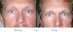 eyesthetica ptosis surgery
