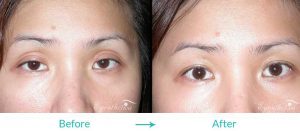 ptosis surgery for asians