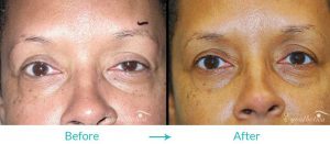 droopy eyelids on left eye