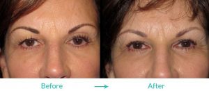 droopy eyelids procedure