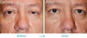 Ptosis Treatment Surgery Los Angeles