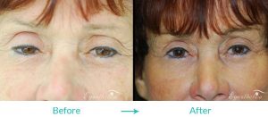 droopy eyelids treatment