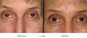 ptosis procedure for the elderly