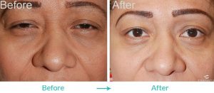 Los Angeles Ptosis Procedure for Droopy Eyelids