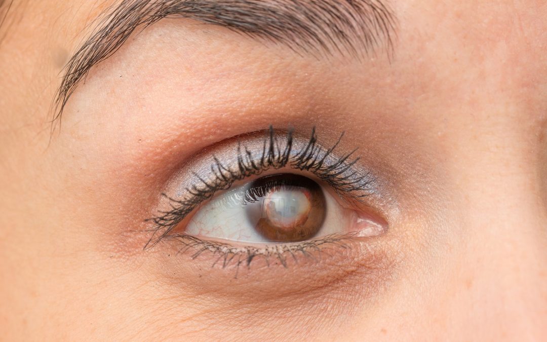 Closing your eyes after eyelid surgery