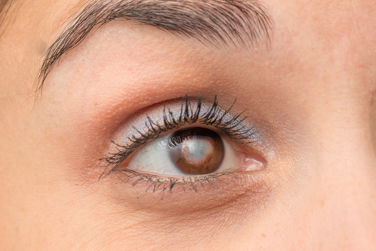 Closing your eyes after eyelid surgery