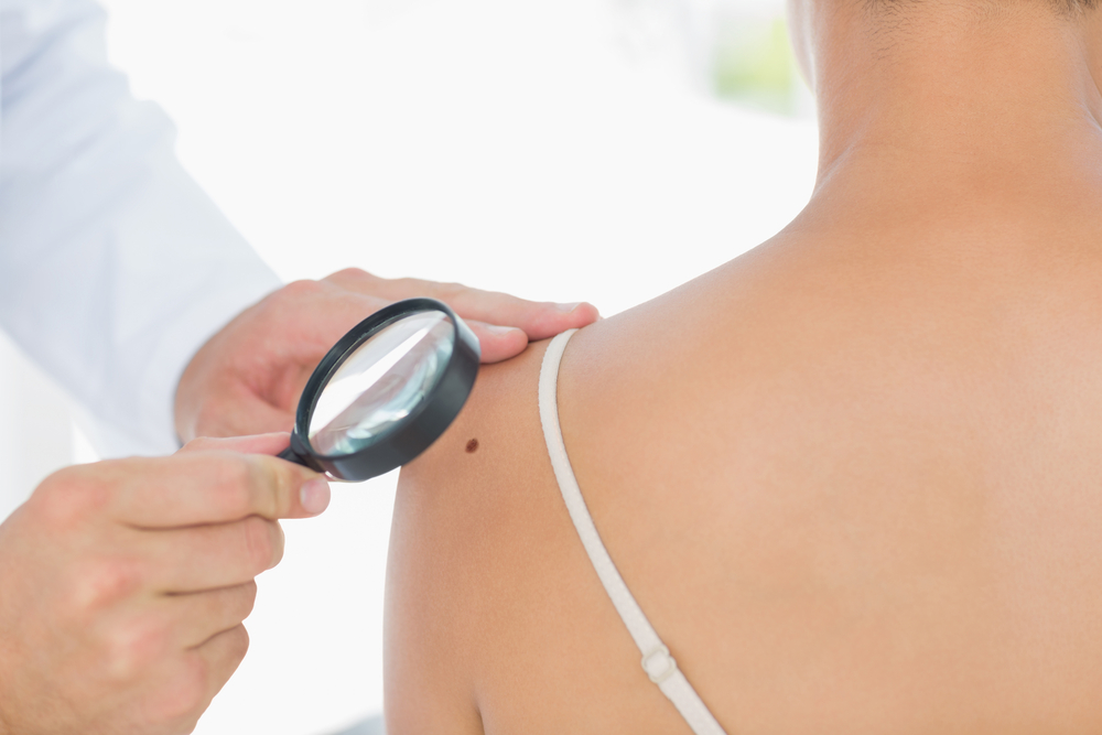 rules of detecting skin cancer