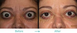 eyesthetica thyroid eye disease treatment