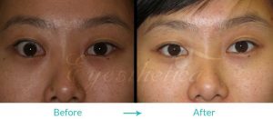 thyroid eye disease treatment