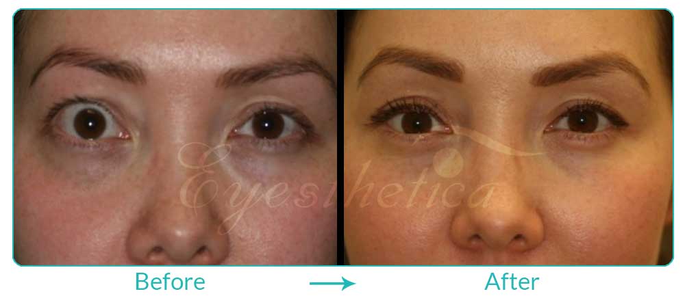 thyroid treatment and eyelid lift procedure