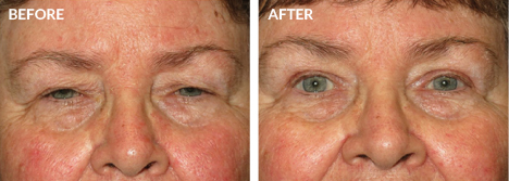 Upper Blepharoplasty