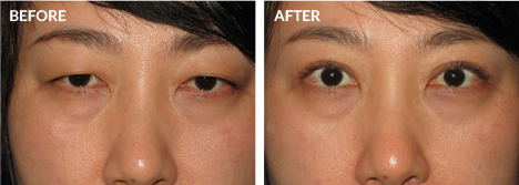 Asian Eyelid Surgery