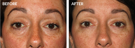 Lower Blepharoplasty