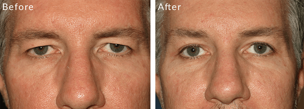 Upper Blepharoplasty Best Results