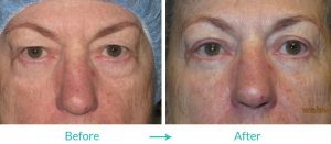 best blepharoplasty treatment in Los Angeles