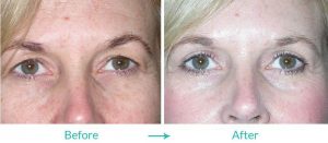 upper blepharoplasty eyelid lift surgery