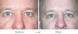 best eyelid surgery in Los Angeles